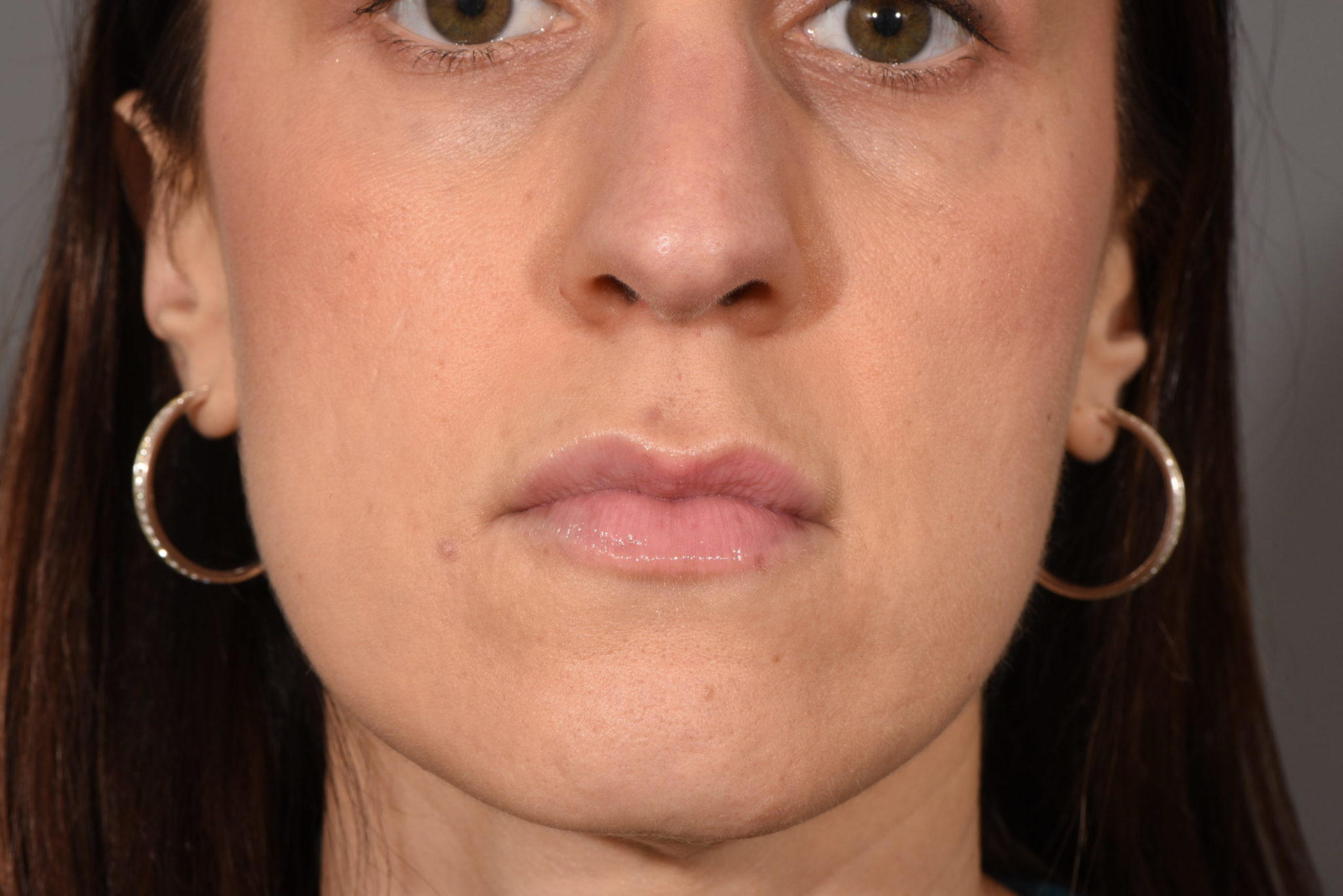 Fillers Patient Photo - Case 5745 - after view-0