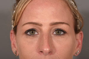 After Fillers Aliso Viejo Orange County