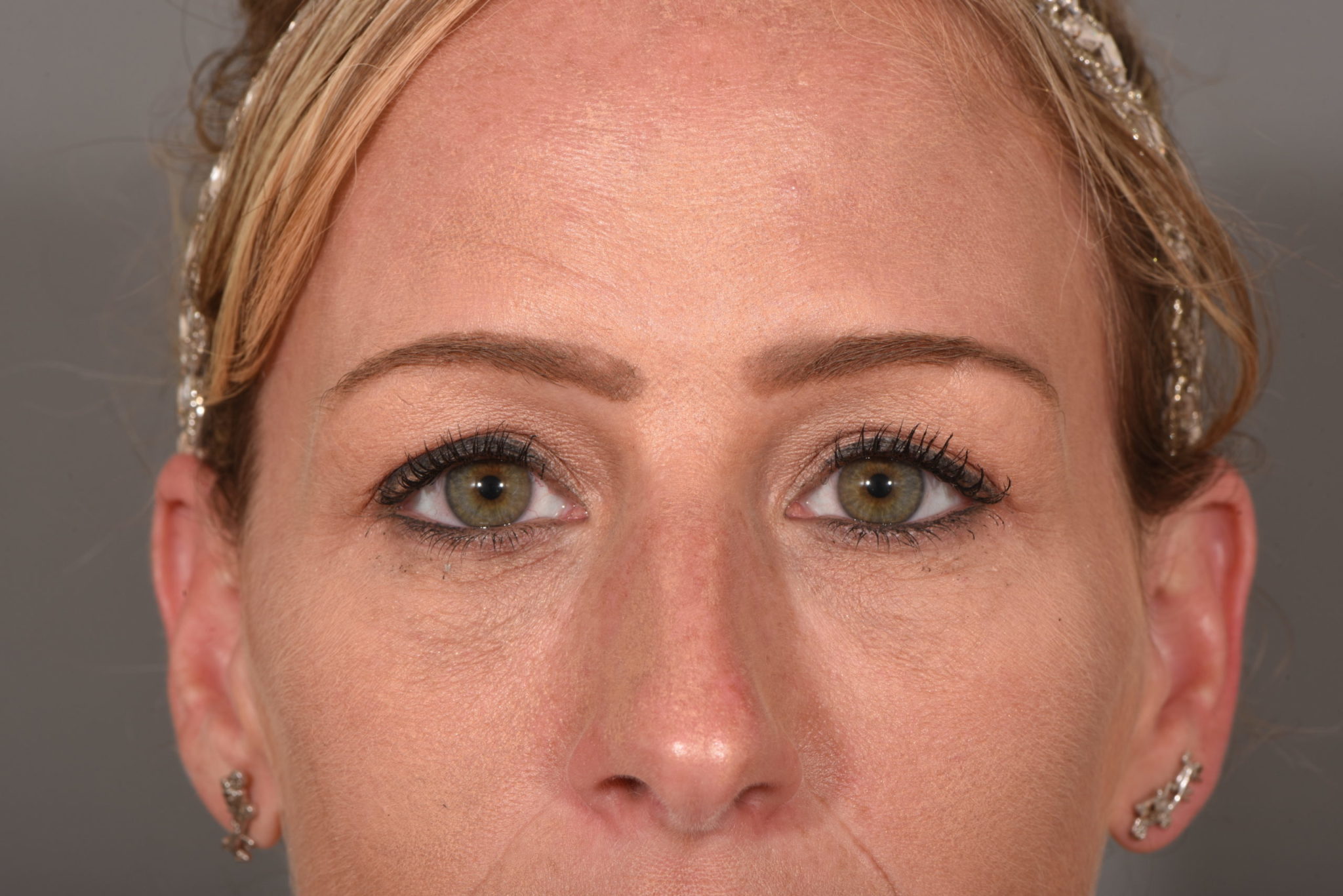 Fillers Patient Photo - Case 5748 - after view