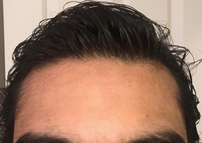 Hair Restoration - Case 5754 - After