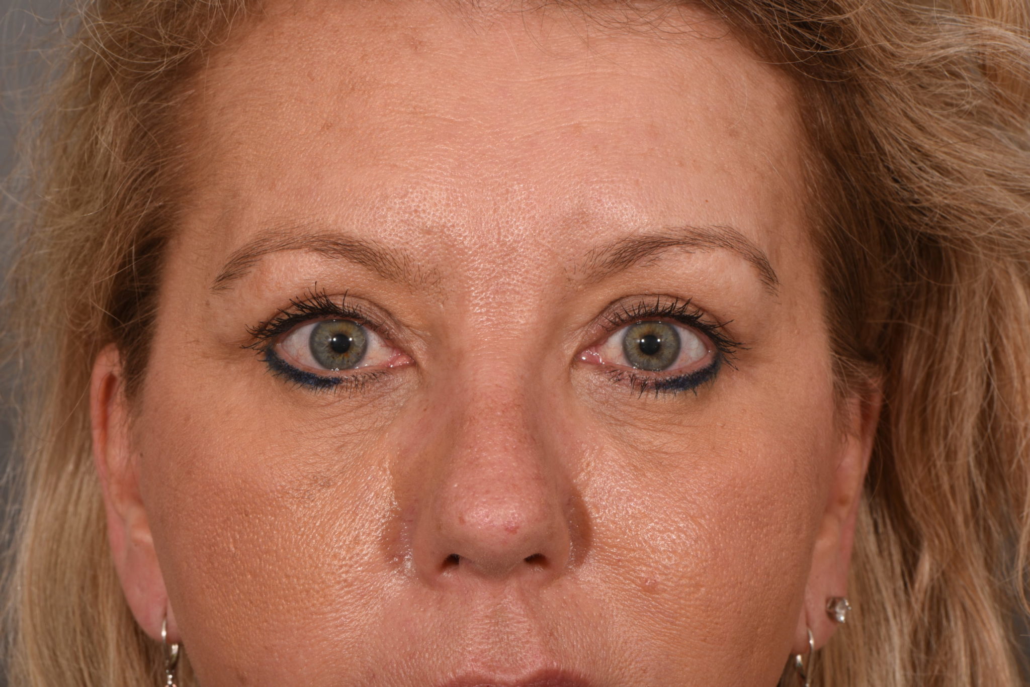 Upper Eyelid Lift Patient Photo - Case 5760 - after view-0