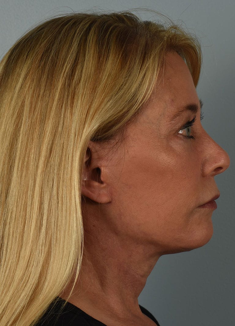 Microlift Patient Photo - Case 7294 - after view-4