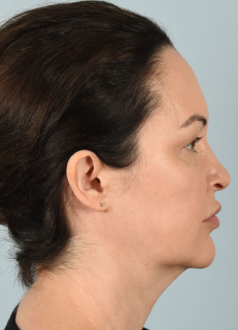 Microlift Patient Photo - Case 7305 - before view-4