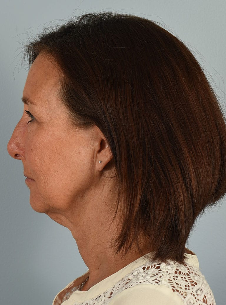 Microlift Patient Photo - Case 7354 - before view-2
