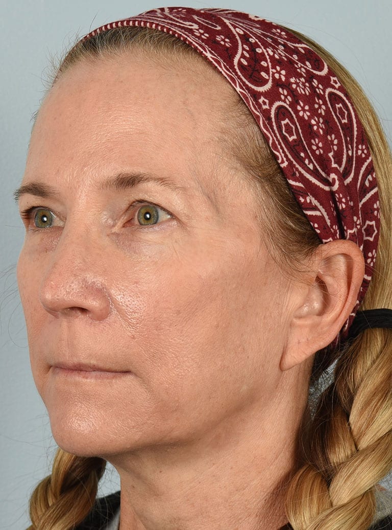 Lower Eyelid Lift/Pinch Patient Photo - Case 7371 - before view-1