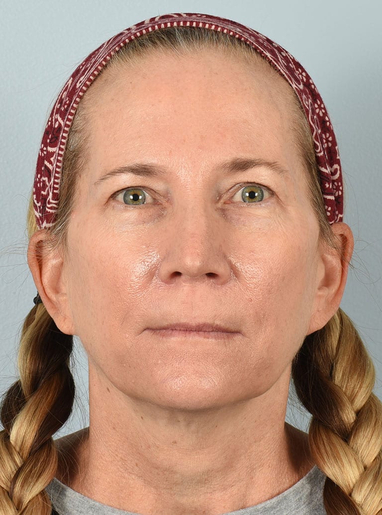 Lower Eyelid Lift/Pinch Patient Photo - Case 7371 - after view