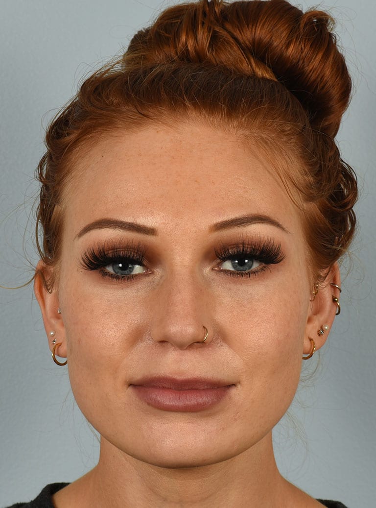 Rhinoplasty Patient Photo - Case 7380 - before view-0