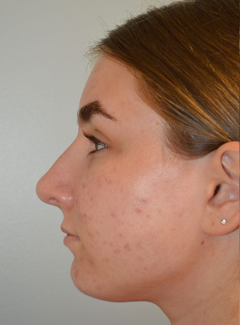 Rhinoplasty Patient Photo - Case 7389 – Click Photos for More - after view-1