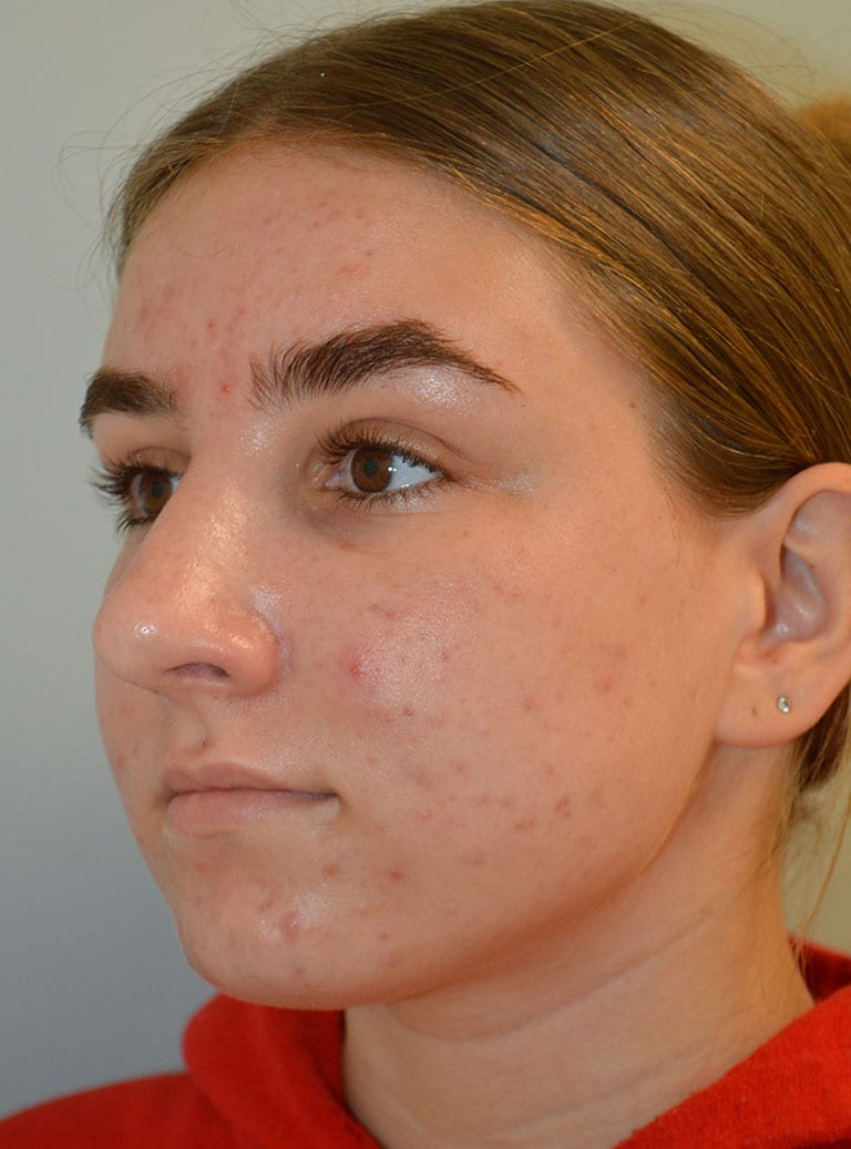 Rhinoplasty Patient Photo - Case 7389 – Click Photos for More - after view