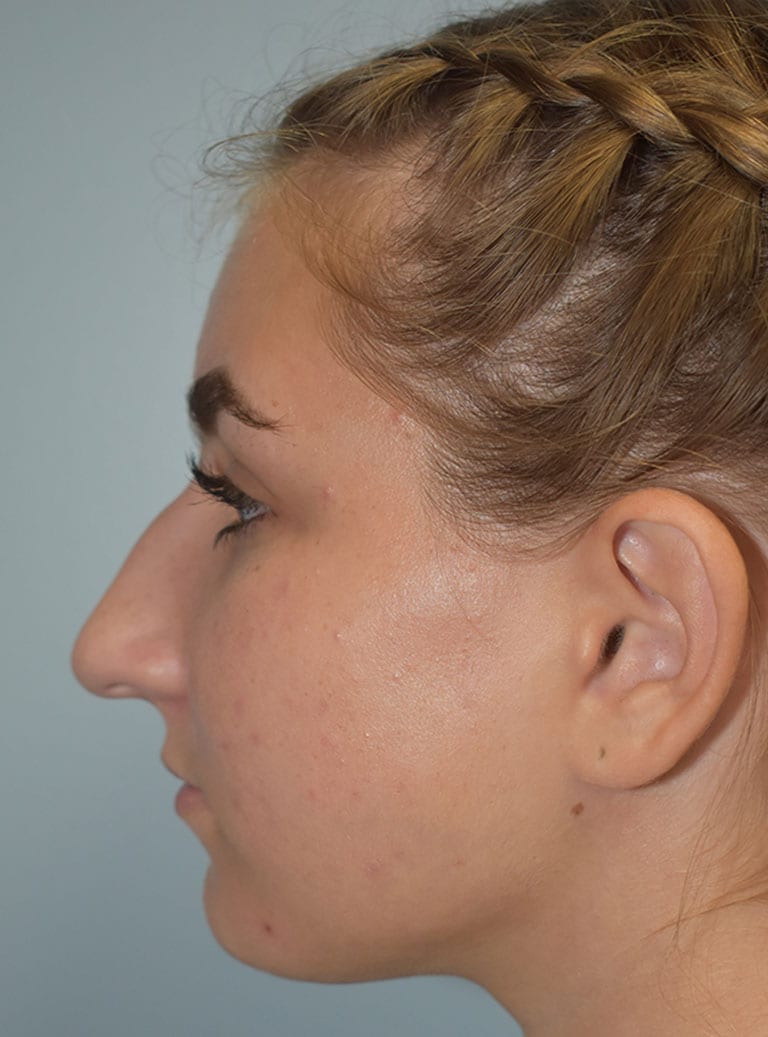 Rhinoplasty Patient Photo - Case 7389 - before view-1