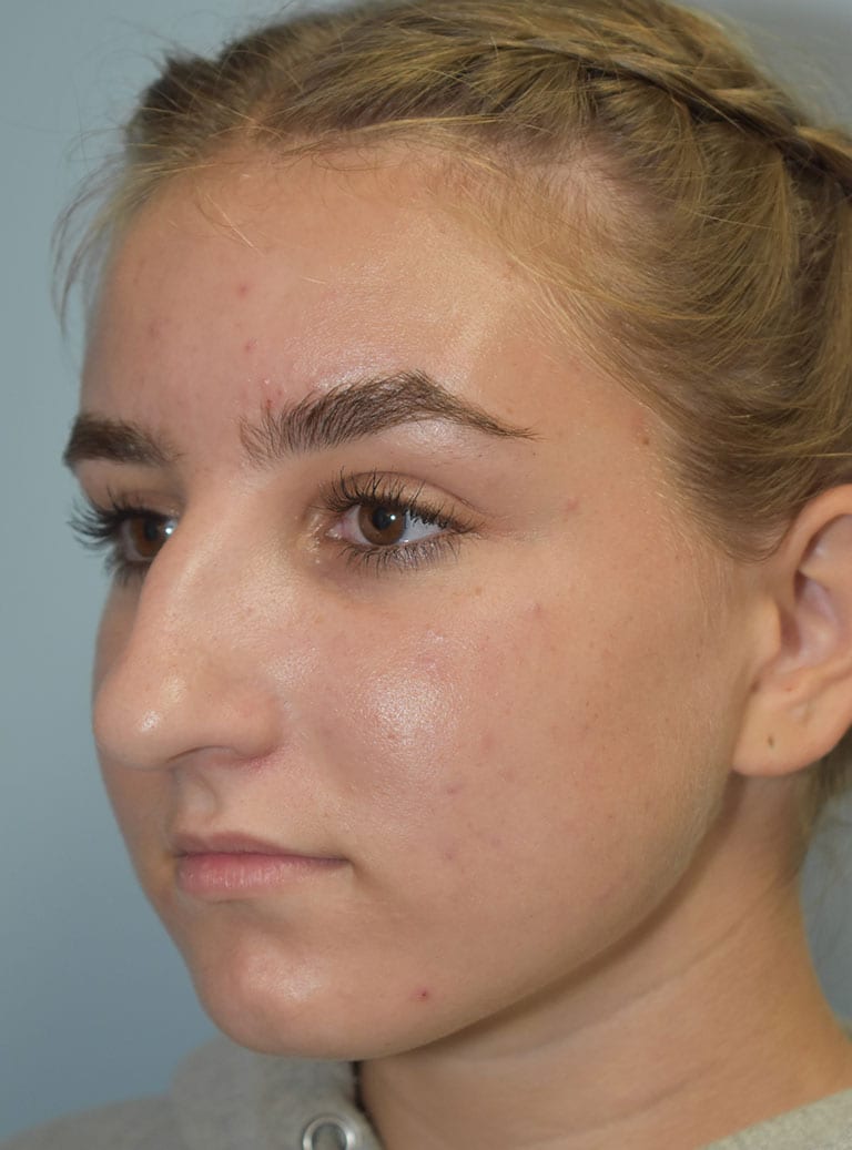 Rhinoplasty Patient Photo - Case 7389 – Click Photos for More - before view-0