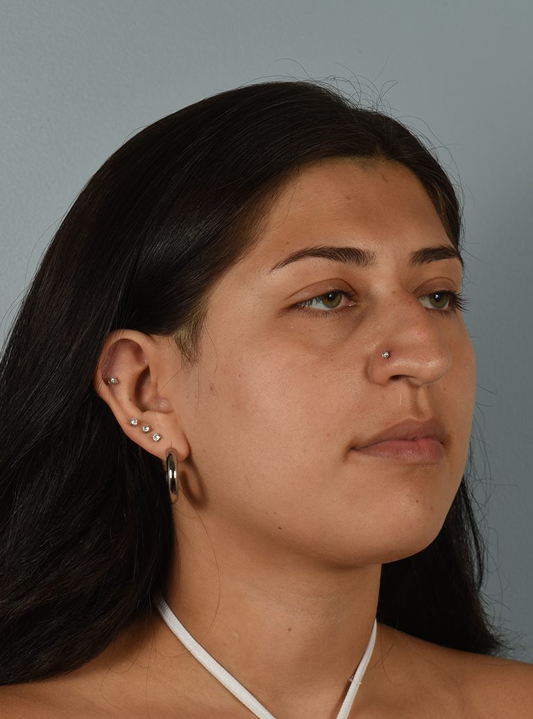 Rhinoplasty Patient Photo - Case 7390 – Click Photos for More - before view-1
