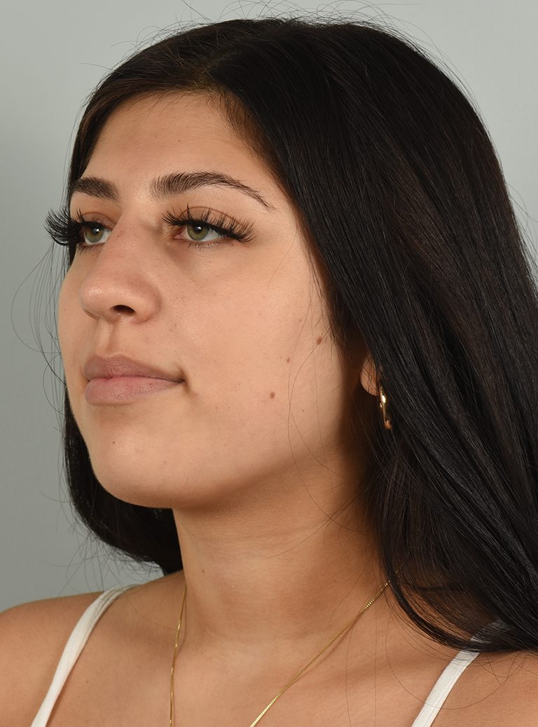 Rhinoplasty Patient Photo - Case 7390 – Click Photos for More - after view-3