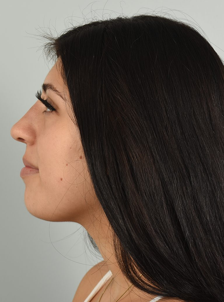 Rhinoplasty Patient Photo - Case 7390 – Click Photos for More - after view-4