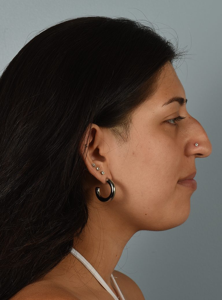 Rhinoplasty Patient Photo - Case 7390 – Click Photos for More - before view-2