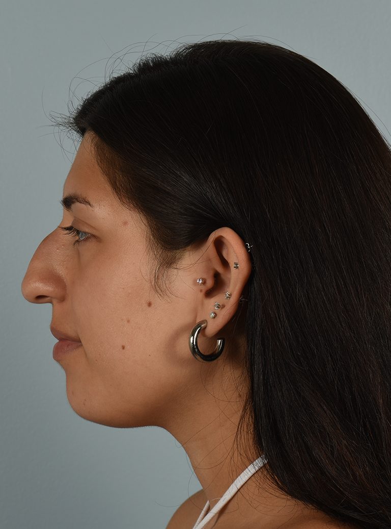 Rhinoplasty Patient Photo - Case 7390 – Click Photos for More - before view-4