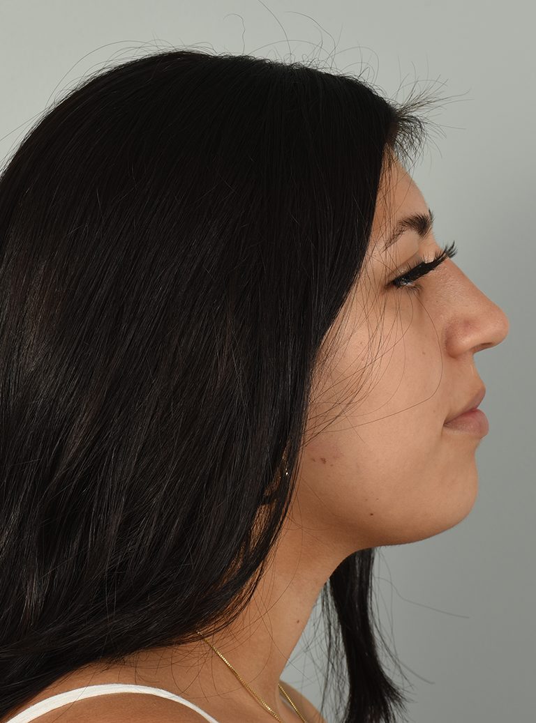 Rhinoplasty Patient Photo - Case 7390 – Click Photos for More - after view-2