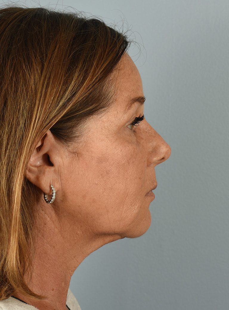 Fractional CO2 Laser Patient Photo - Case 8295 - before view-4