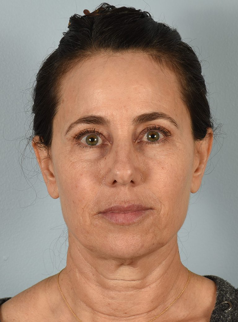 Fractional CO2 Laser Patient Photo - Case 8317 - before view-0