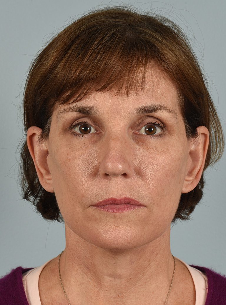 Eyelid Surgery Patient Photo - Case 8339 - after view