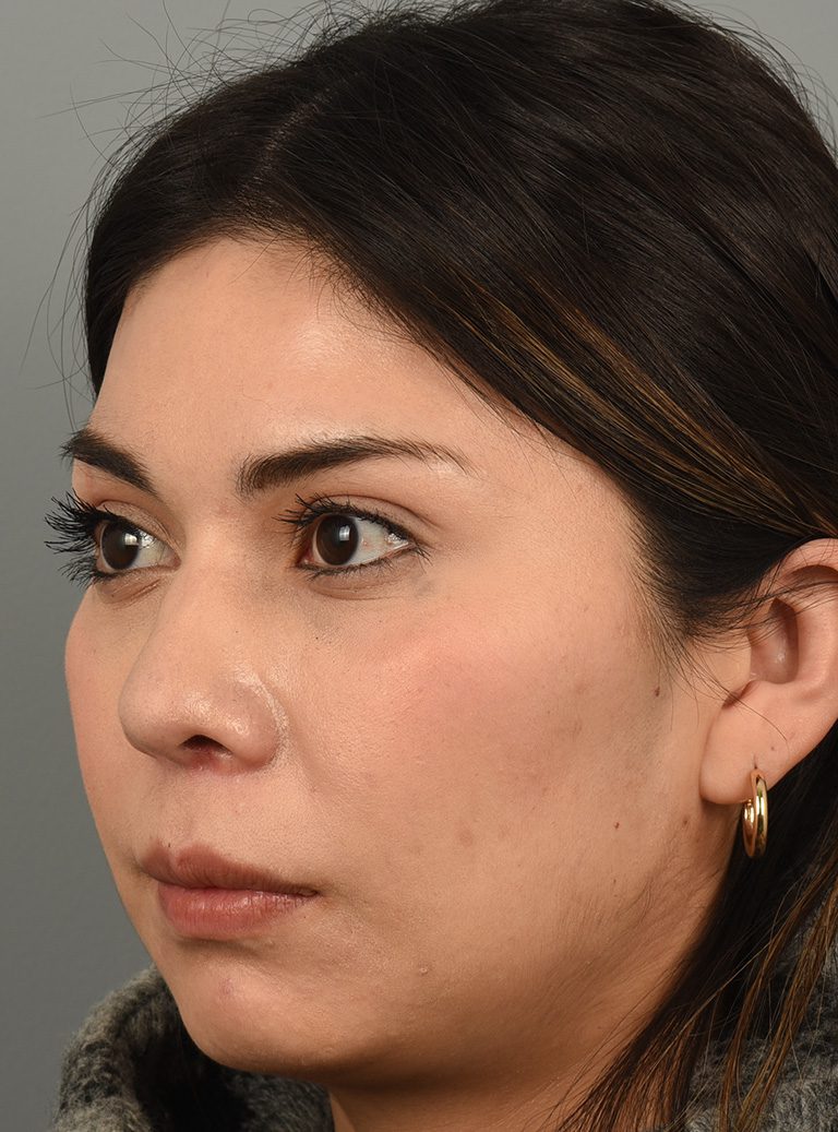 Rhinoplasty Patient Photo - Case 8383 – Click Photos for More - after view-3