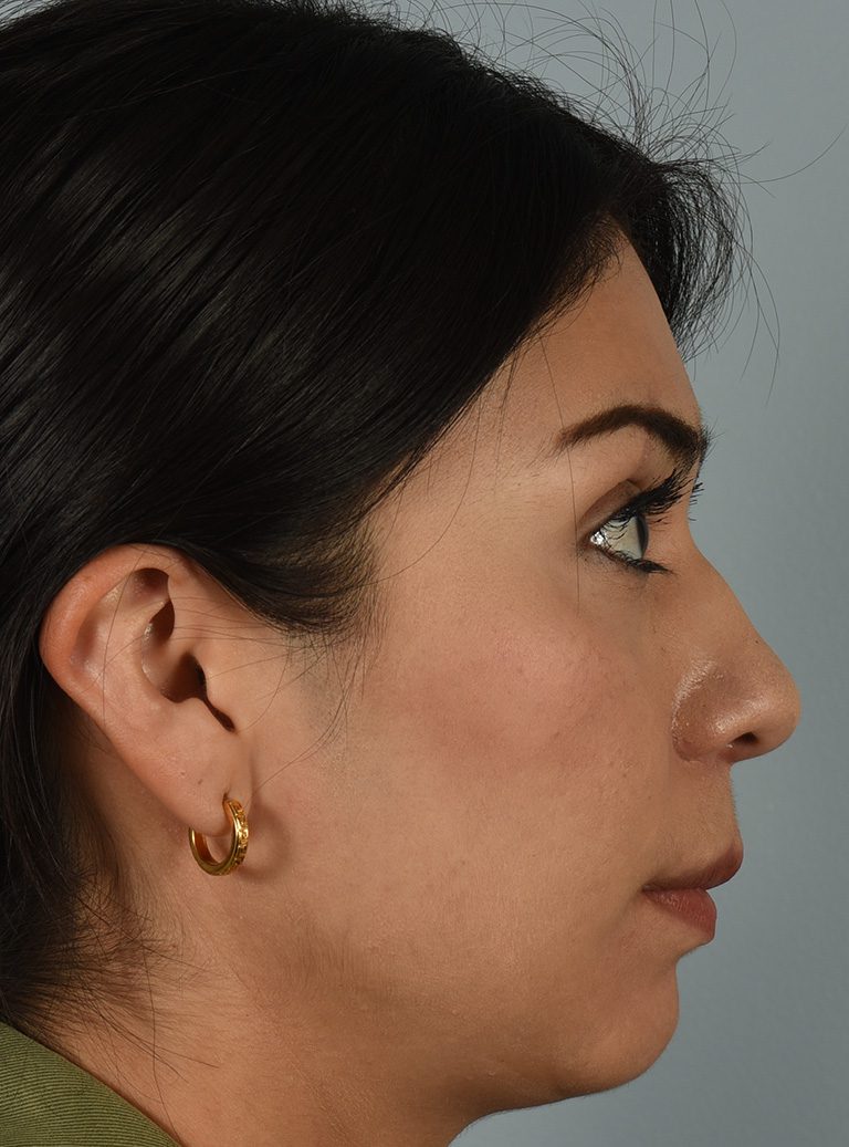 Rhinoplasty Patient Photo - Case 8383 – Click Photos for More - before view-2
