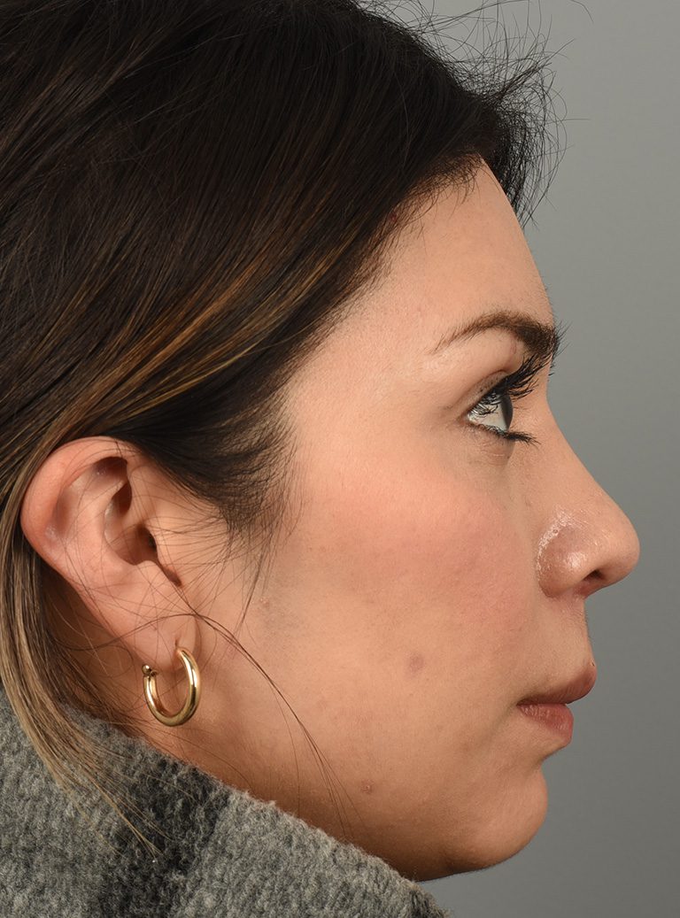 Rhinoplasty Patient Photo - Case 8383 – Click Photos for More - after view-2