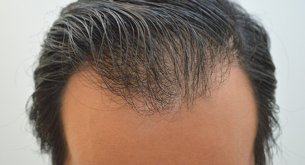 Hair Restoration Patient Photo - Case 8392 - before view-