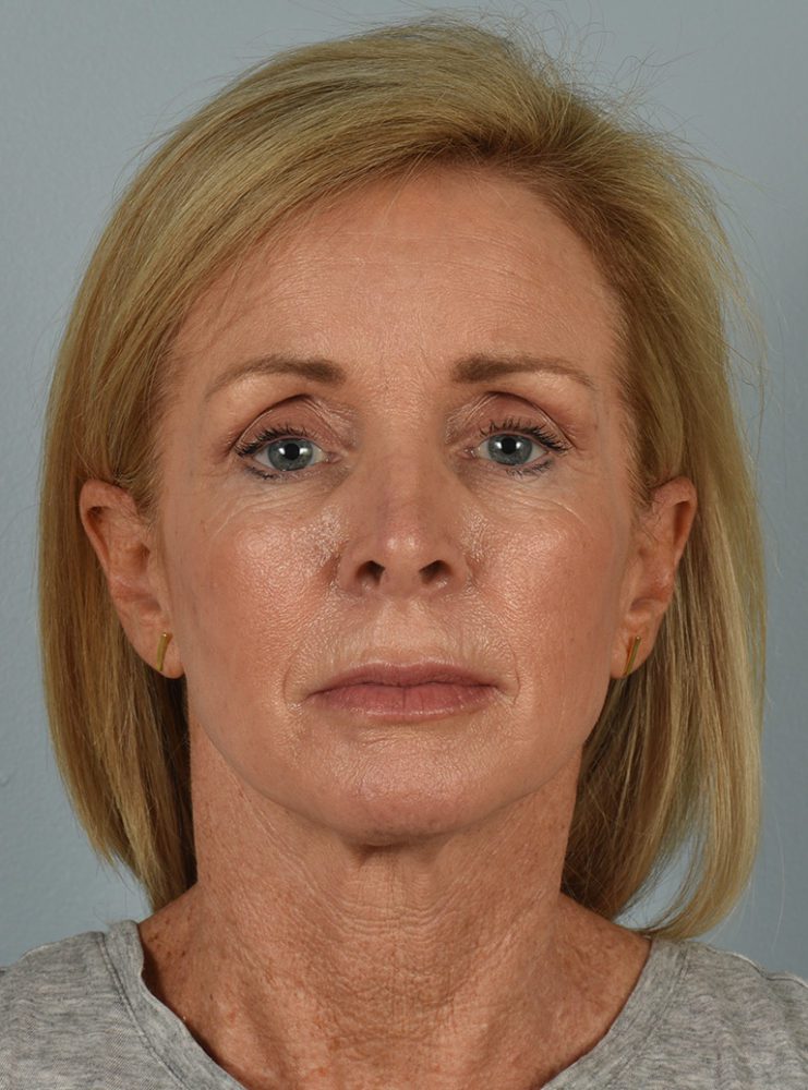 Facelift in Aliso Viejo Orange County - 3a - Before Facelift/Necklift Surgery