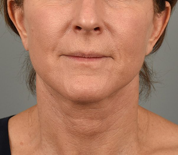 Facelift in Aliso Viejo Orange County - 2b - After Facelift/Necklift Surgery
