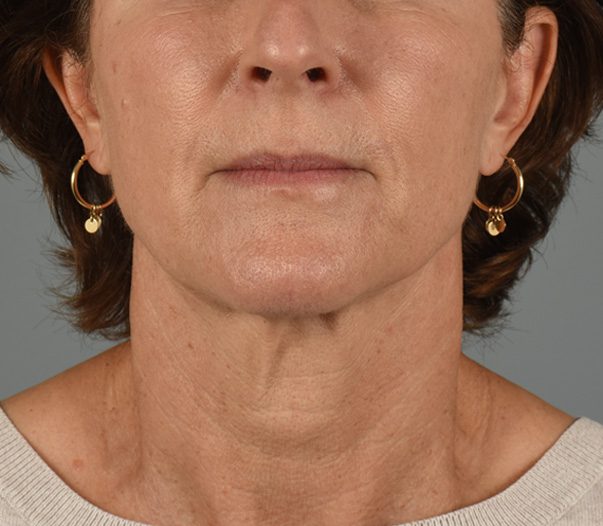 Facelift in Aliso Viejo Orange County - 2a - Before Facelift/Necklift Surgery