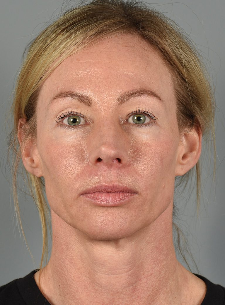 Upper Eyelid Lift Patient Photo - Case 8628 - before view-