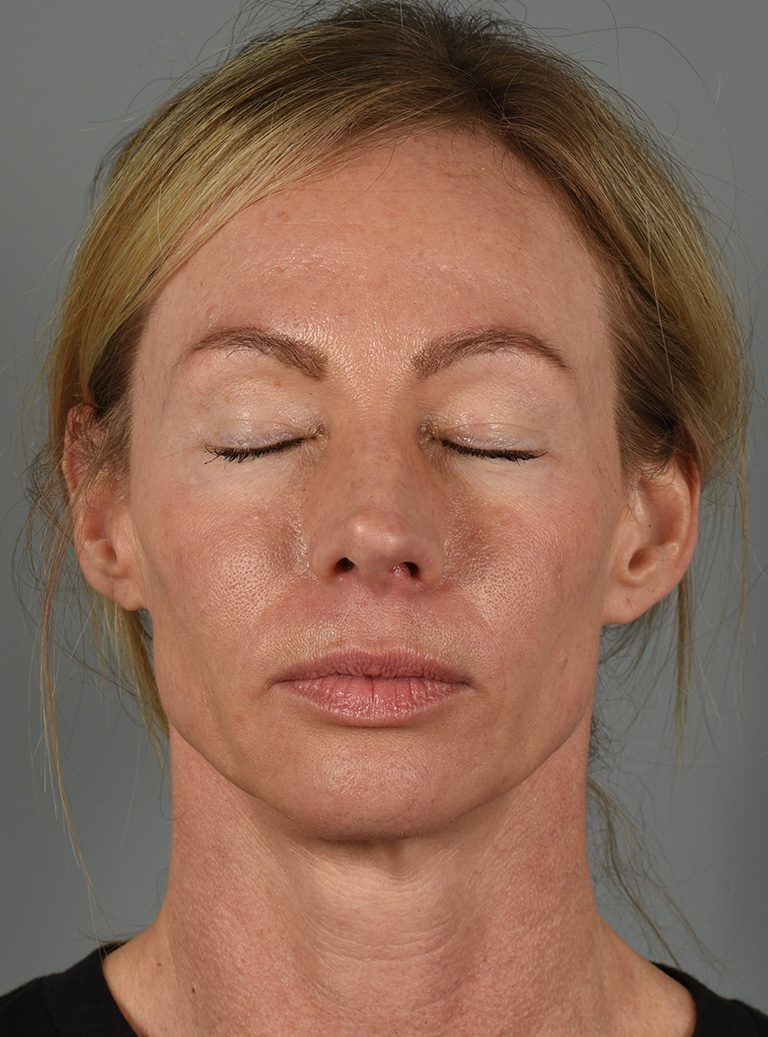 Upper Eyelid Lift Patient Photo - Case 8628 - before view-1