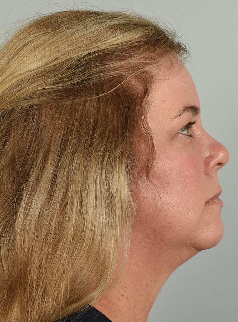 Fractional CO2 Laser Patient Photo - Case 8641 - before view-5
