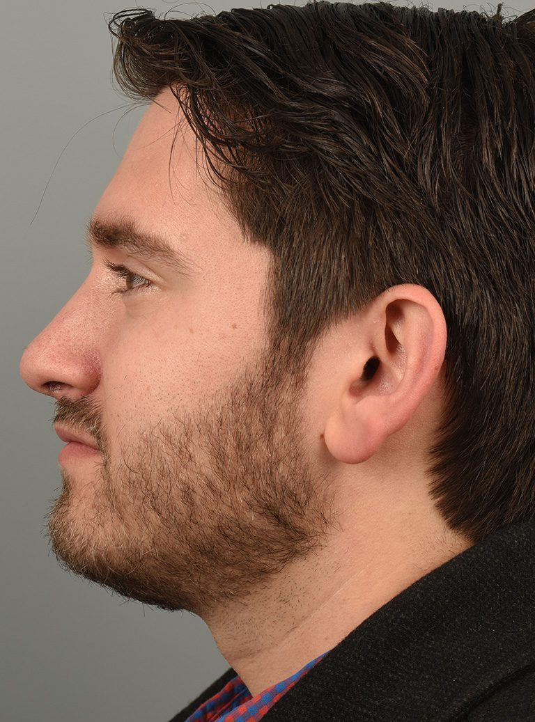 Rhinoplasty Patient Photo - Case 8654 – Click Photos for More - after view-4