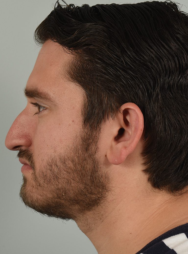 Rhinoplasty Patient Photo - Case 8654 - before view-2