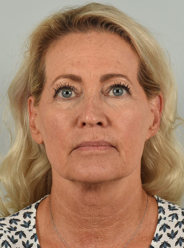 Facelift in Aliso Viejo Orange County - 1a- Before Facelift/Necklift Surgery