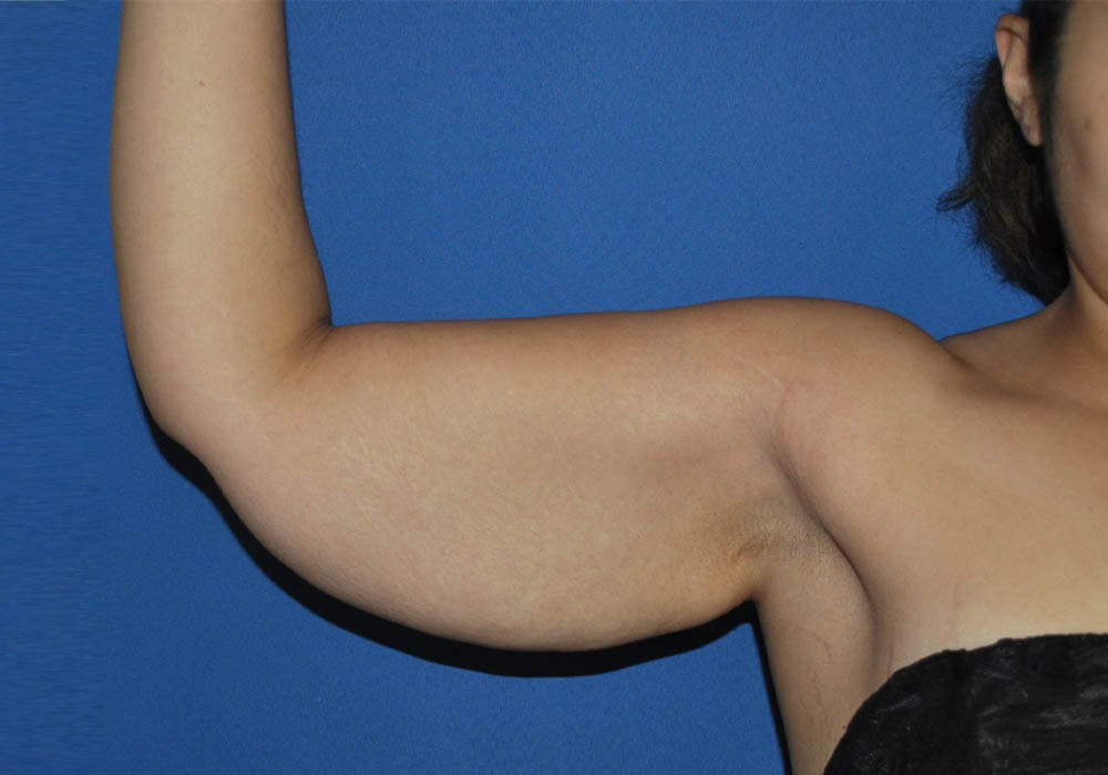 Arm Lift case #3689