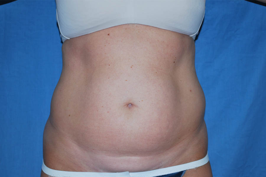 Liposuction case #4503