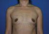 Breast Augmentation case #3879