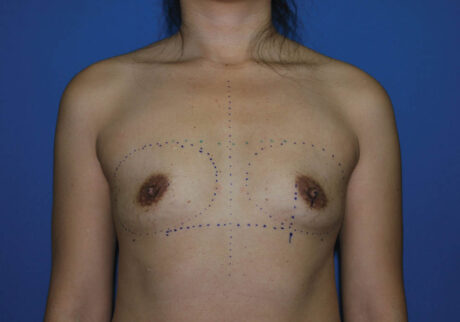 Breast Augmentation case #3879