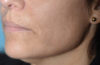 Fillers case #4339