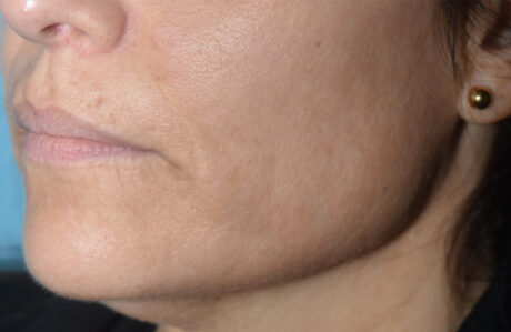Fillers case #4339