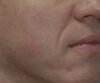 Fillers case #4342