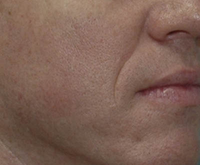 Fillers case #4342