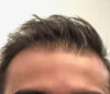 Hair Restoration case #3665