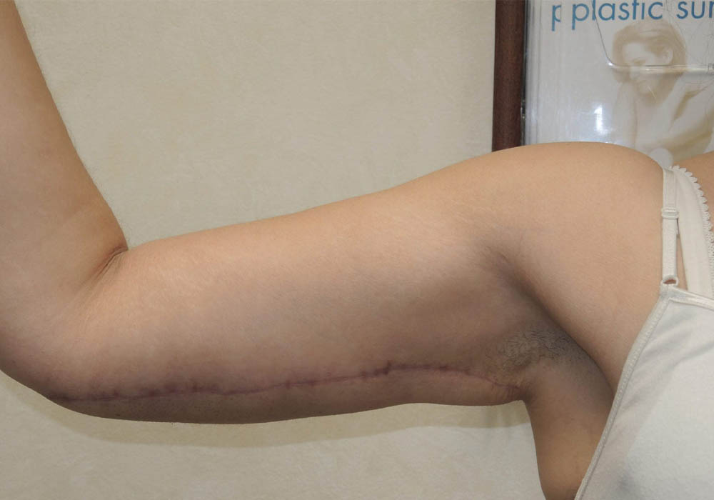 Arm Lift case #3689