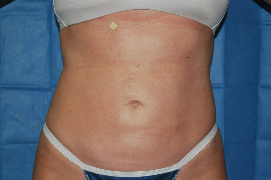 Liposuction case #4503