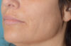 Fillers case #4339