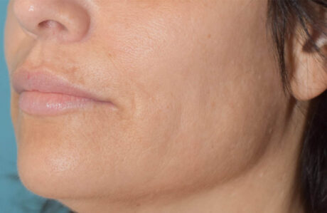 Fillers case #4339